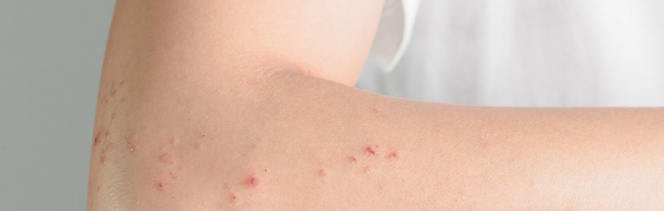 arm with shingles rash