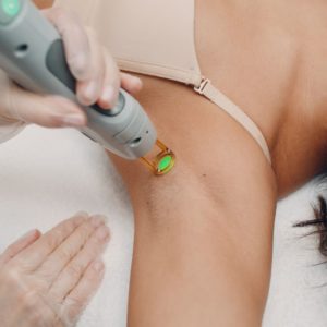 laser hair removal of woman