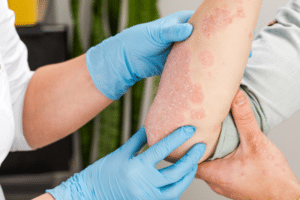 A dermatologist wearing gloves examines the skin of a sick patient