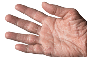 Eczema with redness swellings bumps and flakes on the hand and fingers of a man