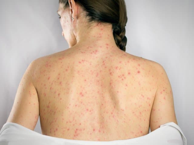 Womans back with shingles disease on skin