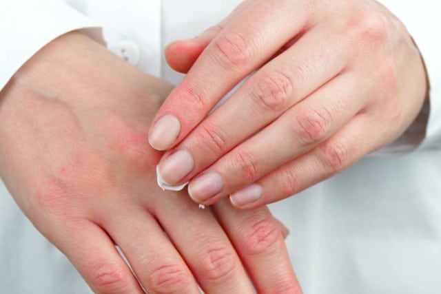 A woman applies the cream to irritated skin with dermatitis