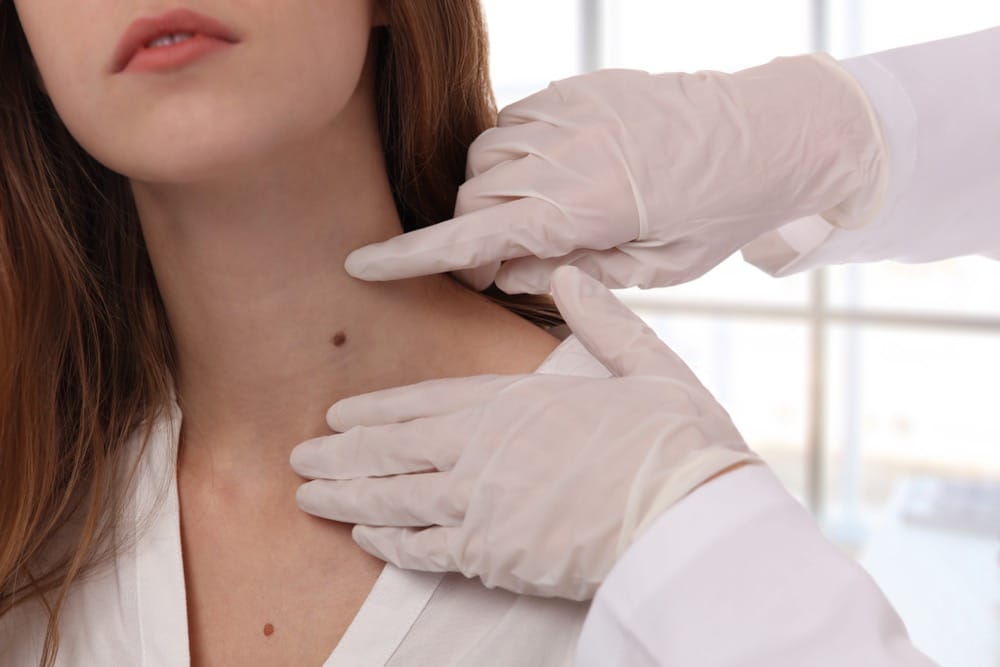 Doctor dermatologist examines birthmark of patient close up. Checking benign moles. Laser Skin tags removal