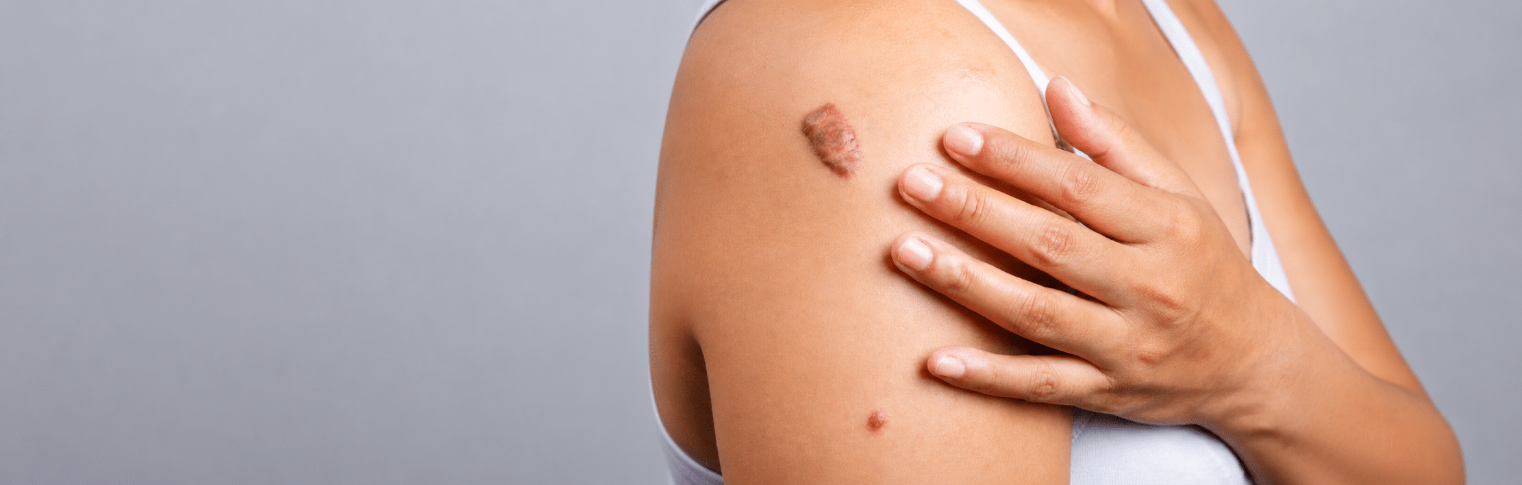 A woman's shoulder with raised keloid scar